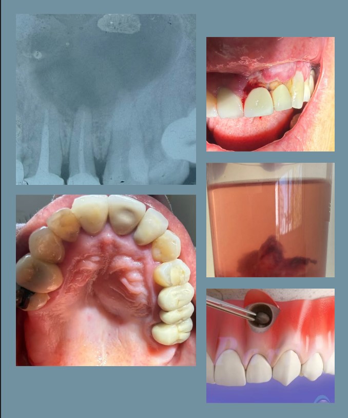 Donde quitarme quistes dentales en Puebla